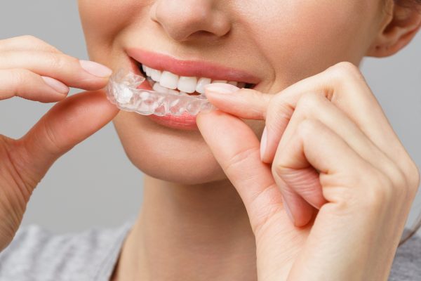 Benefícios para a saúde de ter uma dentadura alinhada