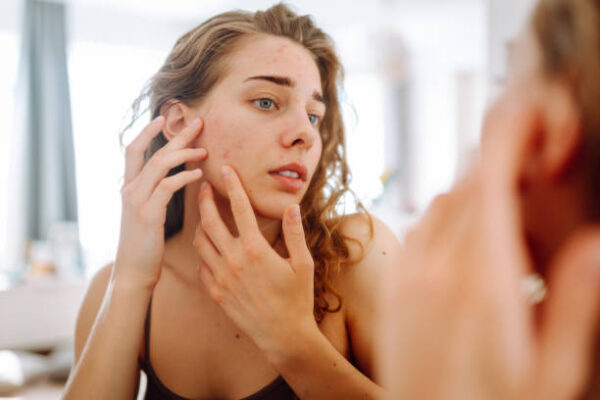Pele com Acne na Idade Adulta: Cuidados Exclusivos e Eficazes